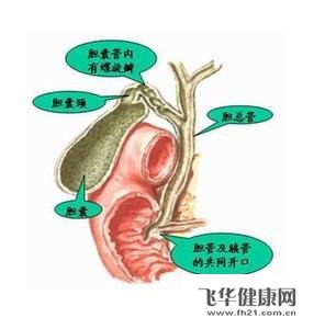 胆结石是指胆囊或胆管被胆固醇等形成的结石引起的一些右上腹疼痛