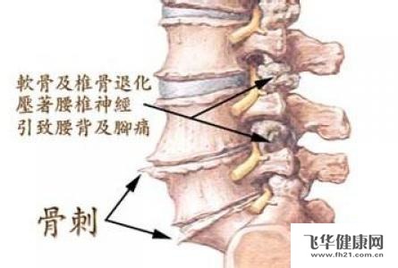 骨关节病里的骨质增生是怎么回事