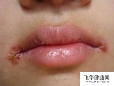 1              口角炎通常人们所说的烂嘴角,是因为白色念珠菌