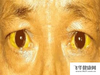 眼白变黄一定是肝炎吗