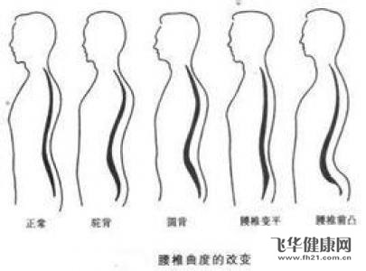腰椎生理弯曲