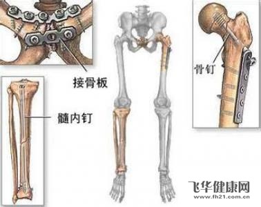 股骨颈骨折手术后吃什么食物有助于骨骼和身体恢复