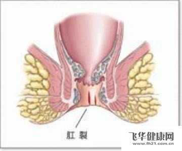 时候有出血,于是急忙带她到医院去看医生,医生检查后说是患了产后肛裂