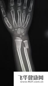 影响骨折愈合的全身性因素和局部因素