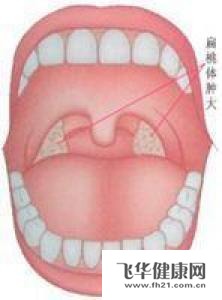 改善扁桃体肿大的方法?