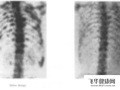 原发性恶性肿瘤常出现骨膜反应,其形状可呈葱皮样,阳光放射状及codman