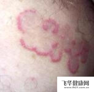 怎么样治疗股癣