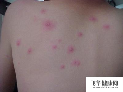 起了水痘在饮食上应该注意些什么