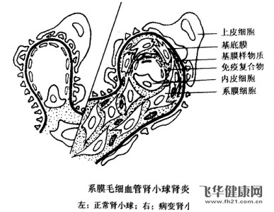 怎么样预防肾小球肾炎