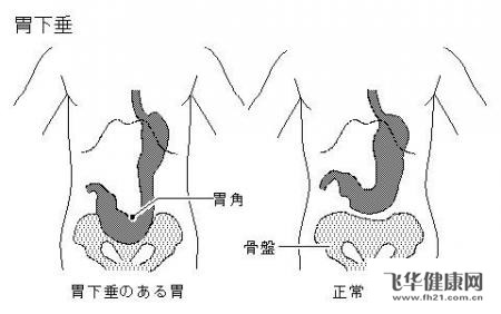 胃有种挤压的痛是不是胃下垂呢