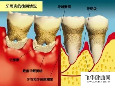 牙周病怎样预防