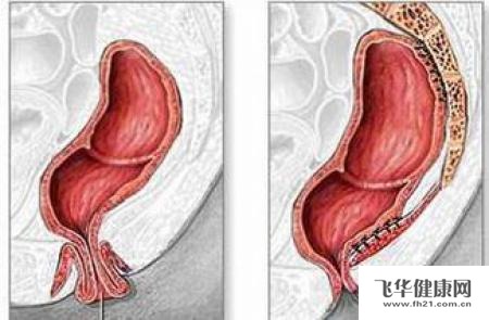 怎么诊断直肠脱垂?