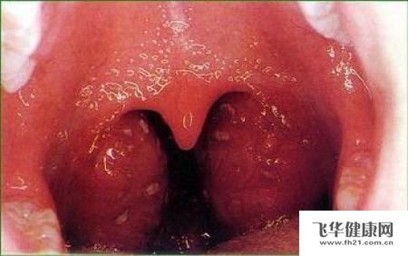 扁桃体发炎是一件很难受的事情,它会让我们的喉咙红肿,吃不下