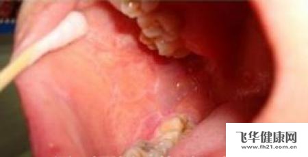 口腔粘膜扁平苔藓复发用什么药治疗呢