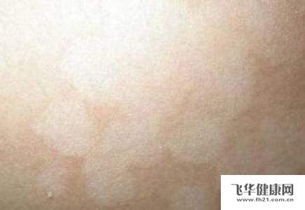 为什么花斑癣会越来越严重