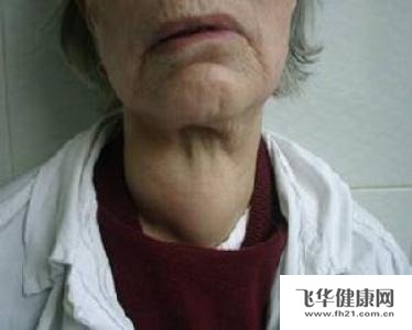 患上甲亢之后患者一定要引起重视,因为甲亢病如果得不到重视的话,病情