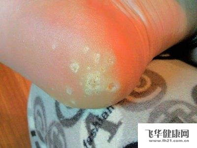 清凉油治鸡眼_鸡眼怎么治