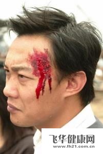 小黄的额头在流血,我疾病百科 急性硬脑膜下血肿 经验分享