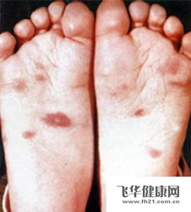 柯萨奇病毒疹的预防