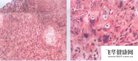 食管鳞状细胞癌应注意什么