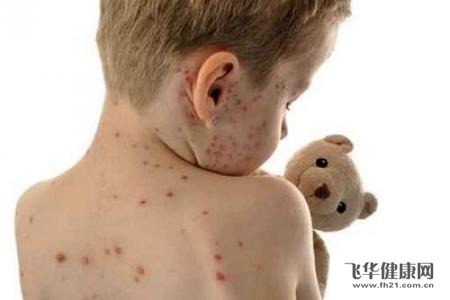水痘疫苗可以预防多久水痘