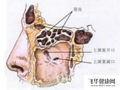 外公得了筛窦恶性肿瘤,怎么办好