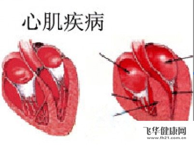 如何知道自己患了限制型心肌病