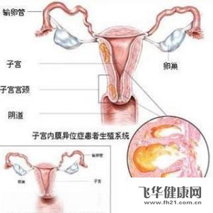 疾病百科 子宫直肠凹子宫内膜异位症 经验分享          4