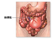 肠梗阻的症状及治疗方法