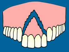 牙槽骨骨折