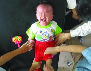 小儿肌张力低下型脑瘫中医治疗