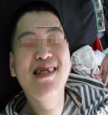 男子不随意运动型脑瘫康复治疗