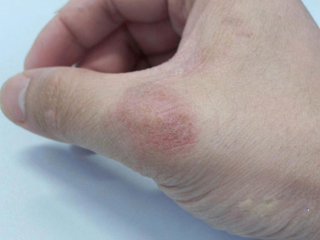 男性银屑病症状大盘点