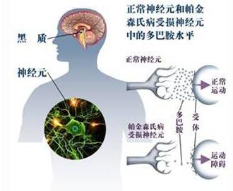 帕金森人口_男性大脑衰老速度更快 更易患帕金森