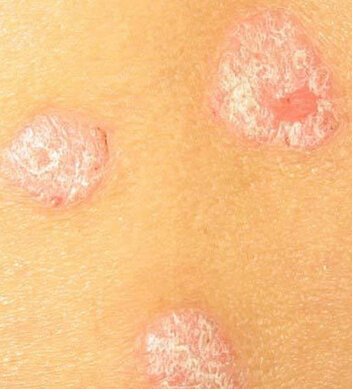 中年寻常型牛皮癣危害