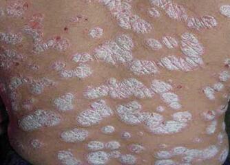 皮肤科 牛皮癣 病因 对于一种疾病来说,病因往往会有很多种,牛皮癣