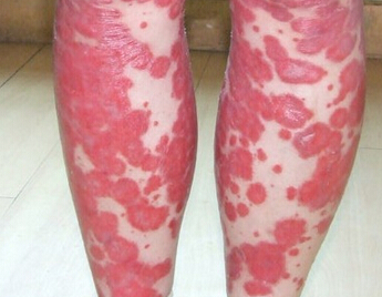 中年红皮病型银屑病中医病因_飞华健康网