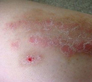 男性脓疱型银屑病危害