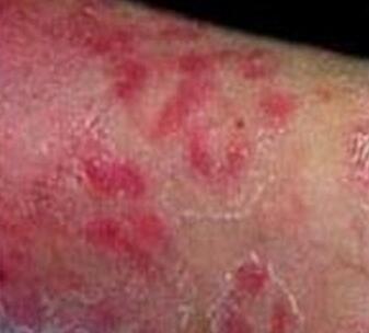 早期红皮型牛皮癣症状