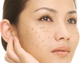 面部色斑形成的原因_飞华健康网