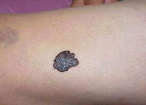 黑色素痣会自己消失吗