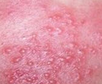 红色斑丘疹的预防与治疗