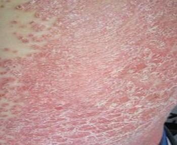 红皮病型牛皮癣内服药_飞华健康网