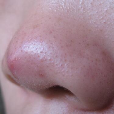 酒糟鼻怎么治疗最好