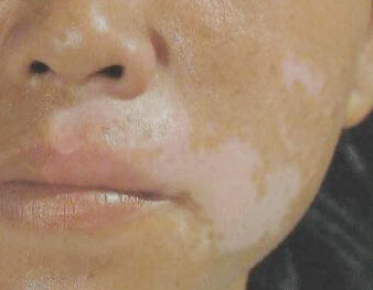 白癜风发病前症状