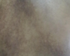 什么是黑皮病呢?