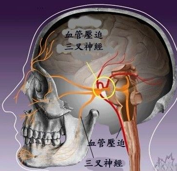 三叉神经痛病因是什么