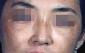 面部黑变病有哪些症状?