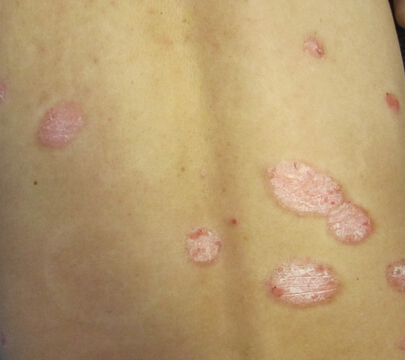 脚上牛皮癣怎么治,牛皮癣早期如何治疗