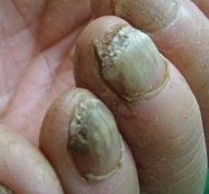 早期灰指甲症状图片